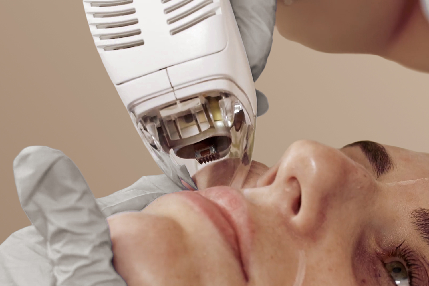 Tixel Skin Resurfacing at Aesthetic Health in Leeds