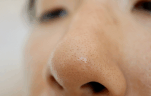 nose pores